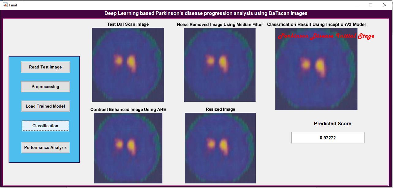 JPM2303-Parkinson's Disease Detection