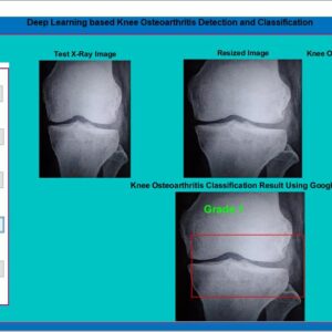JPM2307-Knee Osteoarthritis Detection